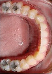 Invisalign Treatment