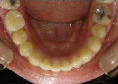 Invisalign Treatment