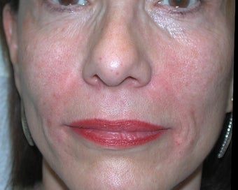 Filler - Nasal Folds