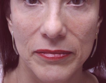 Filler - Nasal Folds