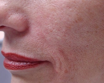 Filler - Nasal Folds