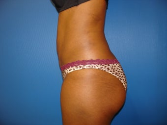 Liposuction