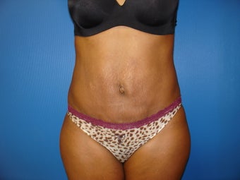 Abdominoplasty (Tummy Tuck)