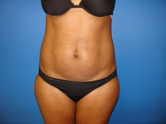 Abdominoplasty (Tummy Tuck)