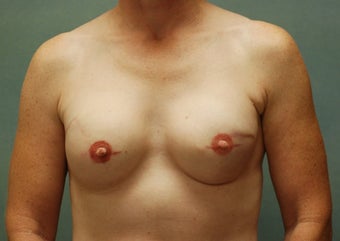 Breast Reconstruction 
