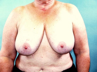 Breast Reconstruction