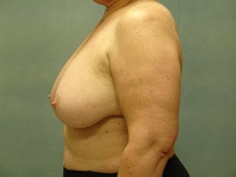 Breast Reconstruction