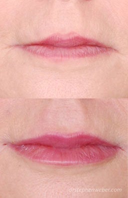 Restylane Lip Injection
