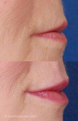 Restylane Lip Injection