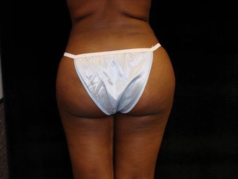 Buttocks Augmentation