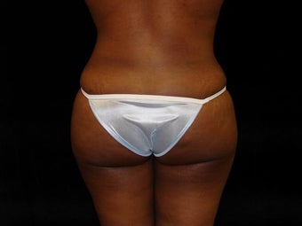 Buttocks Augmentation