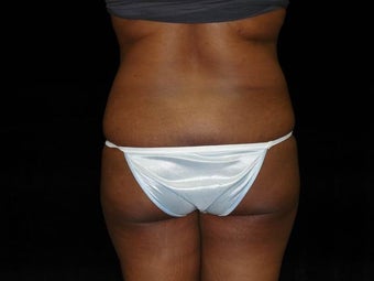 Buttocks Augmentation
