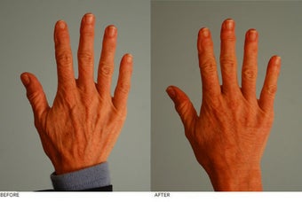 Hand Fat Grafting