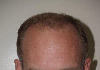 Hair Transplant / 2000 grafts