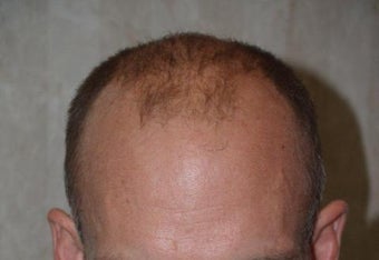 Hair Transplant / 2000 grafts