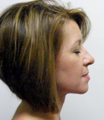 Adult TMJ and orthodontic treatment