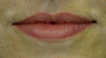 Lip Augmentation