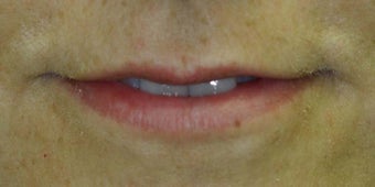 Lip Augmentation