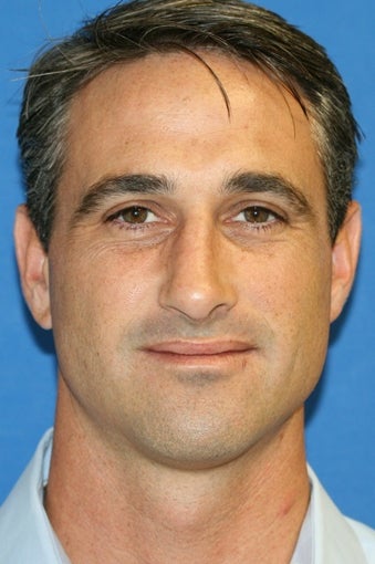Rhinoplasty