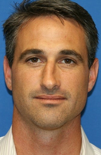 Rhinoplasty