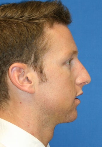 Rhinoplasty