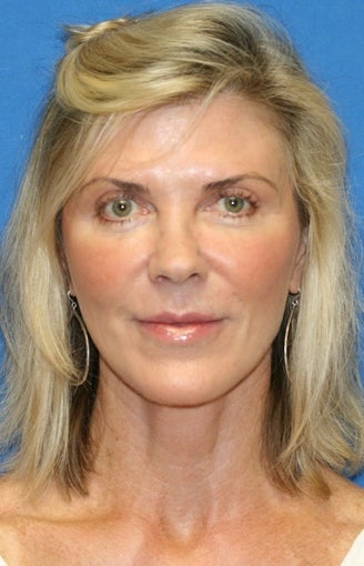 Short Incision face lift and neck lift