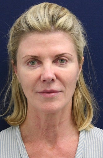 Short Incision face lift and neck lift