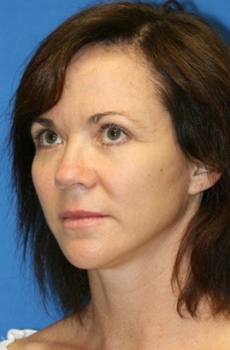 Short Incision facelift, fat transfer, upper blepharoplasty