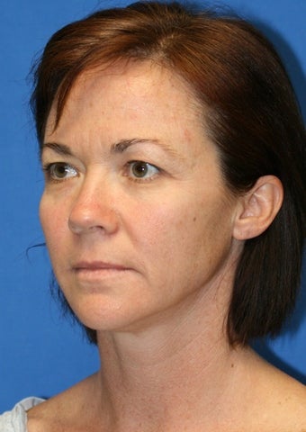 Short Incision facelift, fat transfer, upper blepharoplasty
