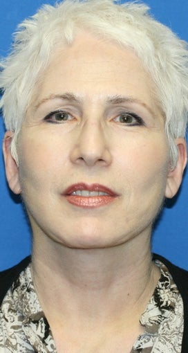 Short Incision face lift and neck lift