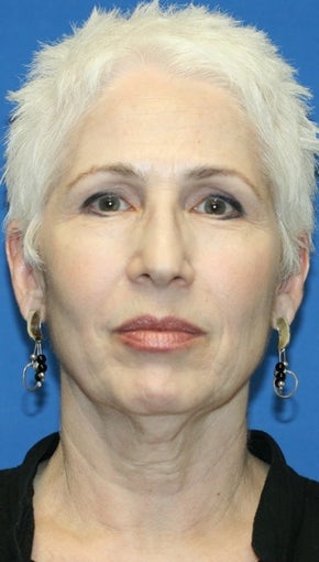 Short Incision face lift and neck lift