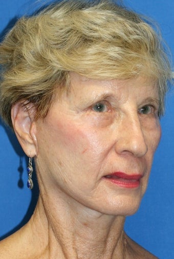 Short Incision face lift and chemical peel