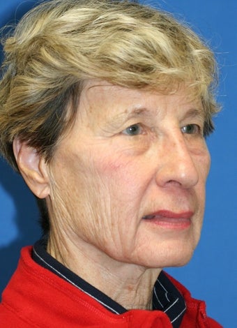 Short Incision face lift and chemical peel