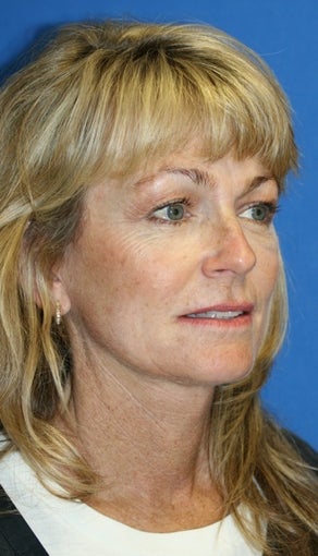 Short Incision face lift and neck lift