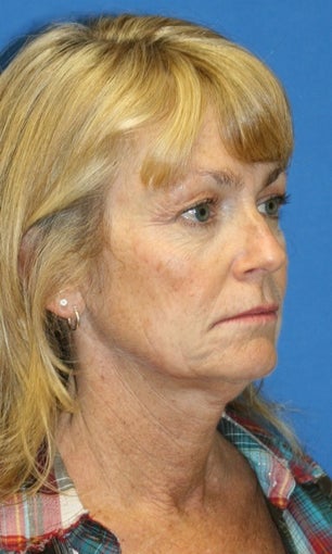 Short Incision face lift and neck lift
