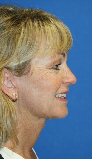 short Incision face lift and neck lift