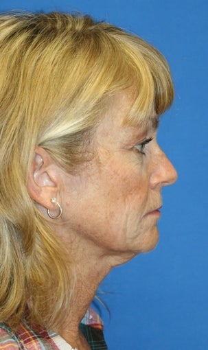 short Incision face lift and neck lift