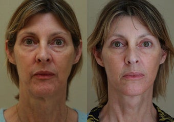 Neck Lift