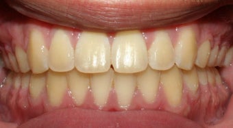Teen Orthodontic Treatment 