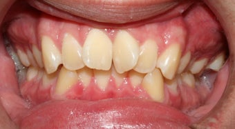 Teen Orthodontic Treatment 