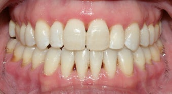 Adult Orthodontic treatment