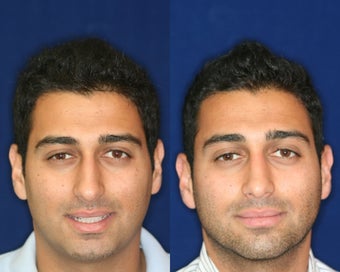 Rhinoplasty and Septoplasty