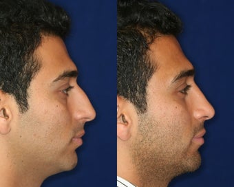 Rhinoplasty and Septoplasty