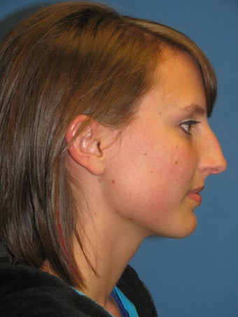 Rhinoplasty