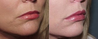 Juvederm Lip Augmentation