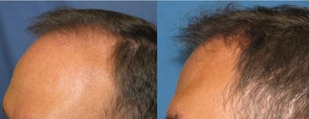 Hair Transplant