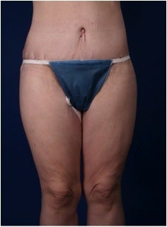 Lower Body Lift after Massive Weight Loss (Gastric Bypass)