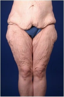 Lower Body Lift after Massive Weight Loss (Gastric Bypass)