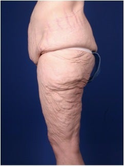 Lower Body Lift after Massive Weight Loss (Gastric Bypass)