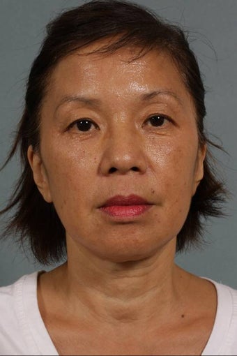 Juvederm LiquidLift